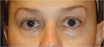 Restylane