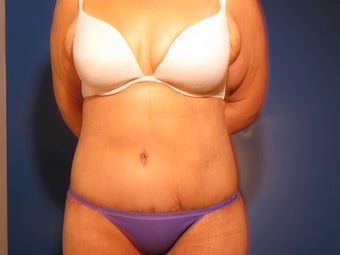 Body Contouring after Massive Weight Loss