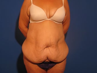 Body Contouring after Massive Weight Loss