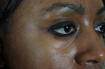 27 year old treated with filler to improve the bags underneath her eyes