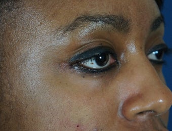 27 year old treated with filler to improve the bags underneath her eyes