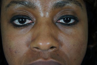 27 year old treated with filler to improve the bags underneath her eyes