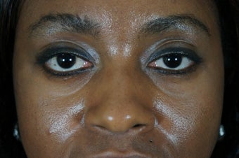 27 year old treated with filler to improve the bags underneath her eyes