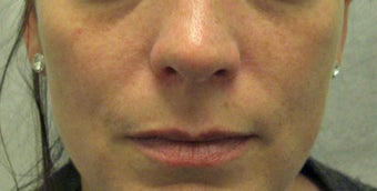 Restlane to the Lips