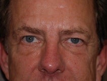 Juvederm to Tear Troughs (lower lids)