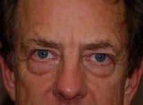 Juvederm to Tear Troughs (lower lids)