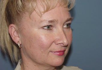Patient requesting  correction for sub-optimal results after esthetic nasal surgery