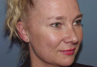 Patient requesting  correction for sub-optimal results after esthetic nasal surgery