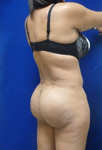 Brazilian Butt lift
