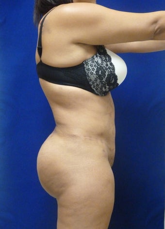 Brazilian Butt lift