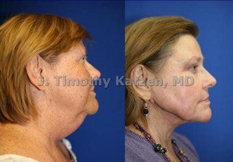Chemical Peel and Neck liposuction