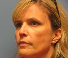 Woman in 40s treated for wrinkles