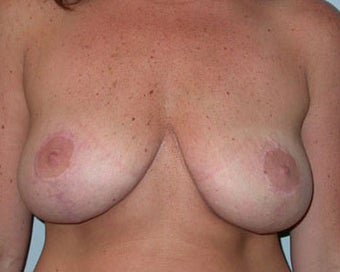Breast Lift Procedure for 38 Year Old Woman 