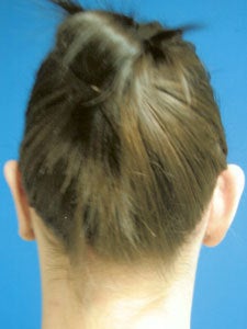 Otoplasty Ear Surgery - Woman