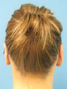 Otoplasty Ear Surgery - Woman