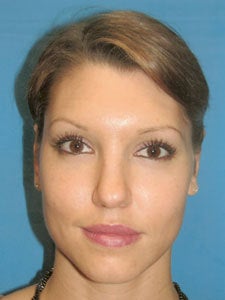 Otoplasty Ear Surgery - Woman