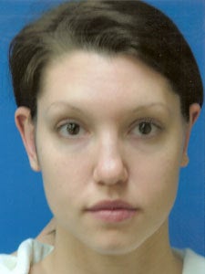 Otoplasty Ear Surgery - Woman