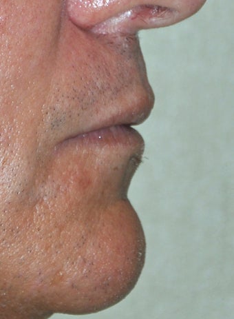 35 Year Old Male Who Desired Larger Lips