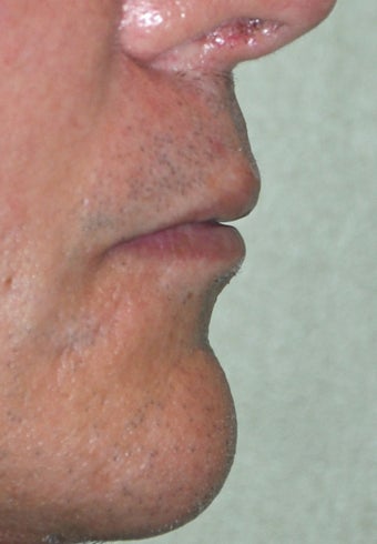 35 Year Old Male Who Desired Larger Lips