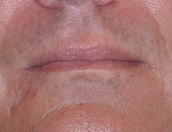 35 Year Old Male Who Desired Larger Lips