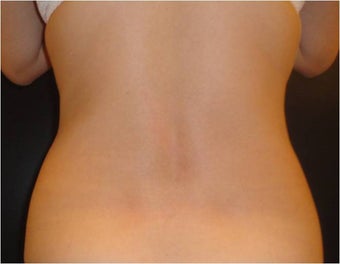 SmartLipo MPX