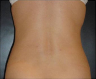 SmartLipo MPX