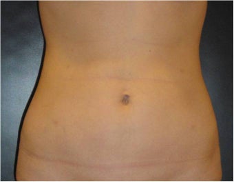 SmartLipo MPX