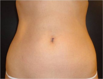 SmartLipo MPX
