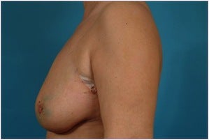 Breast reconstruction - Flap-based