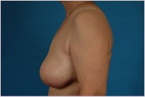 Breast reconstruction - Flap-based