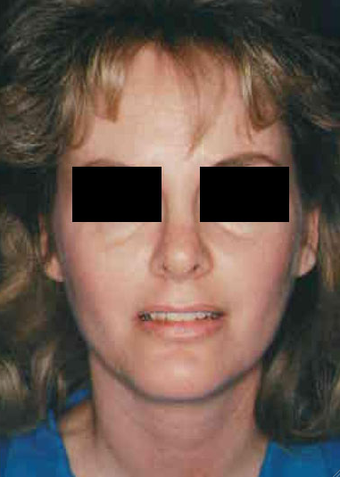 Revision Rhinoplasty