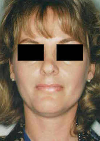 Revision Rhinoplasty