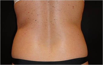 SmartLipo MPX 