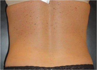 SmartLipo MPX 