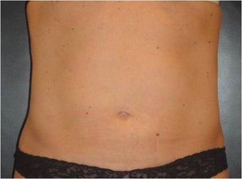 SmartLipo MPX 