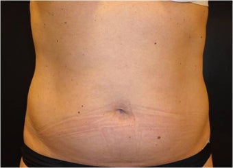 SmartLipo MPX 