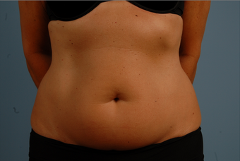 truSculpt- one treatment to abdomen