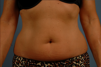 truSculpt- one treatment to abdomen