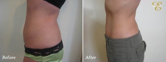 Smart Lipo