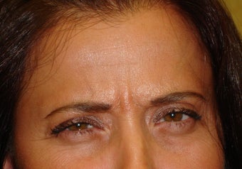 Glabellar Lines