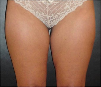 SmartLipo MPX