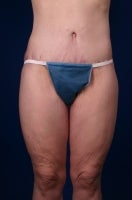 42 Year Old Femal With Medial Thigh Laxity After Weight Loss