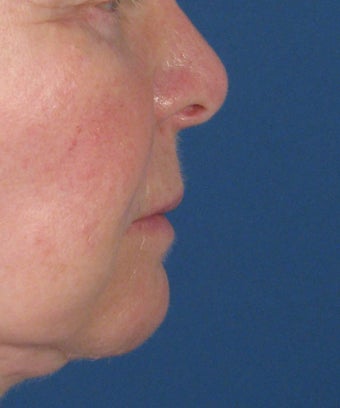 Bullhorn Subnasale Lip Lift