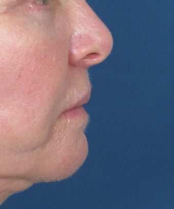 Bullhorn Subnasale Lip Lift