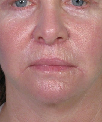 Bullhorn Subnasale Lip Lift