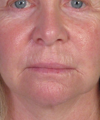 Bullhorn Subnasale Lip Lift