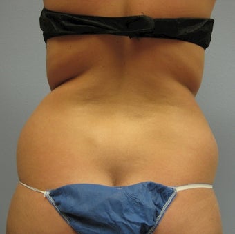 Liposuction of Back, Buttocks and Thighs