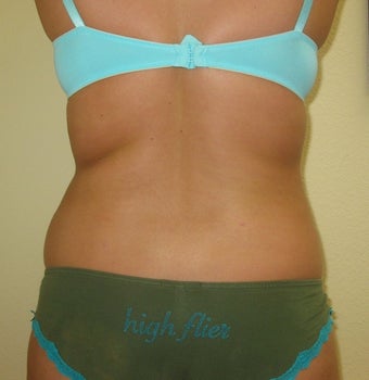 Liposuction of Back, Buttocks and Thighs