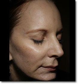 Liquid Facelift