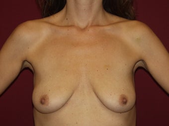 Lift with Breast Implants